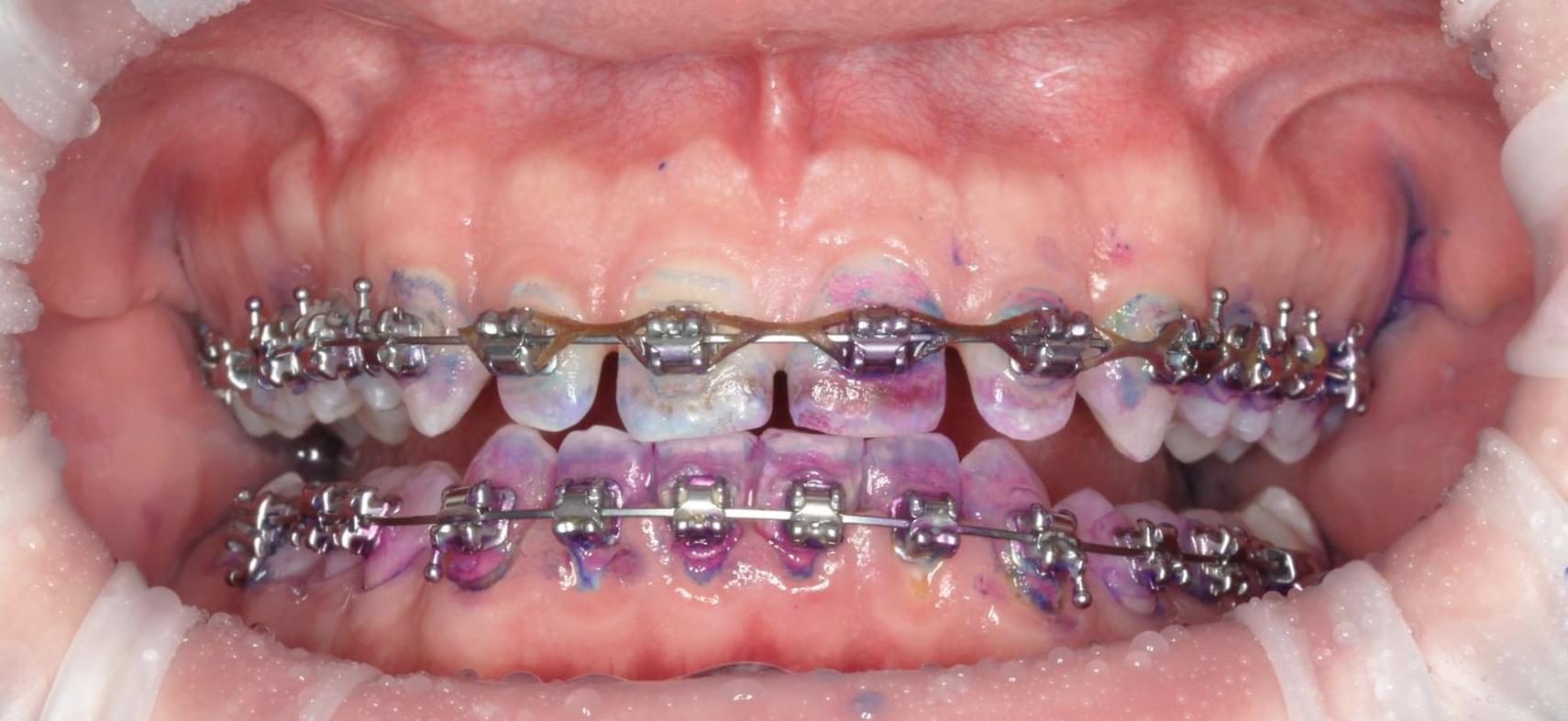 teeth after