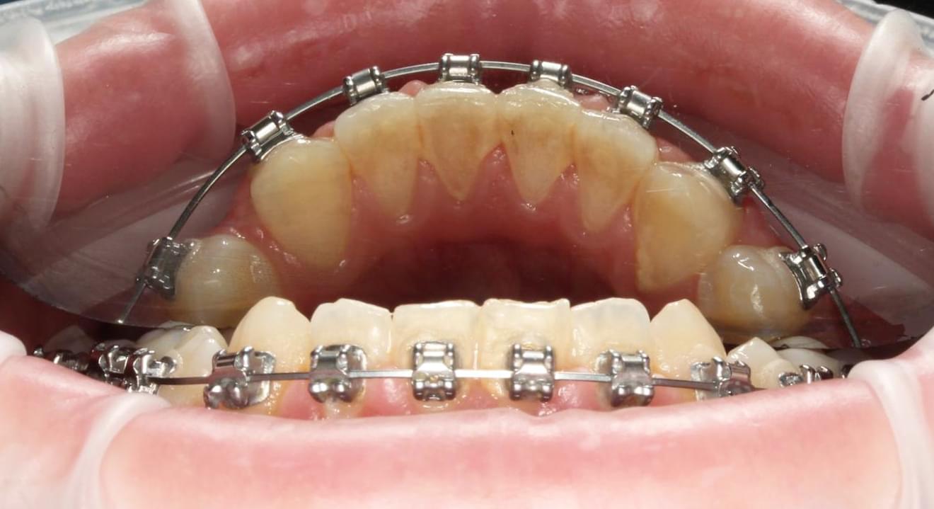 teeth before