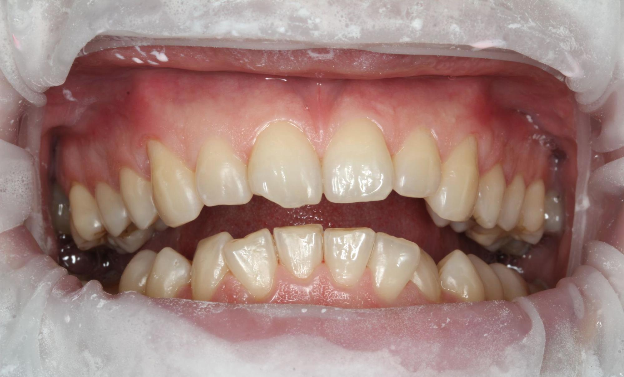 teeth after