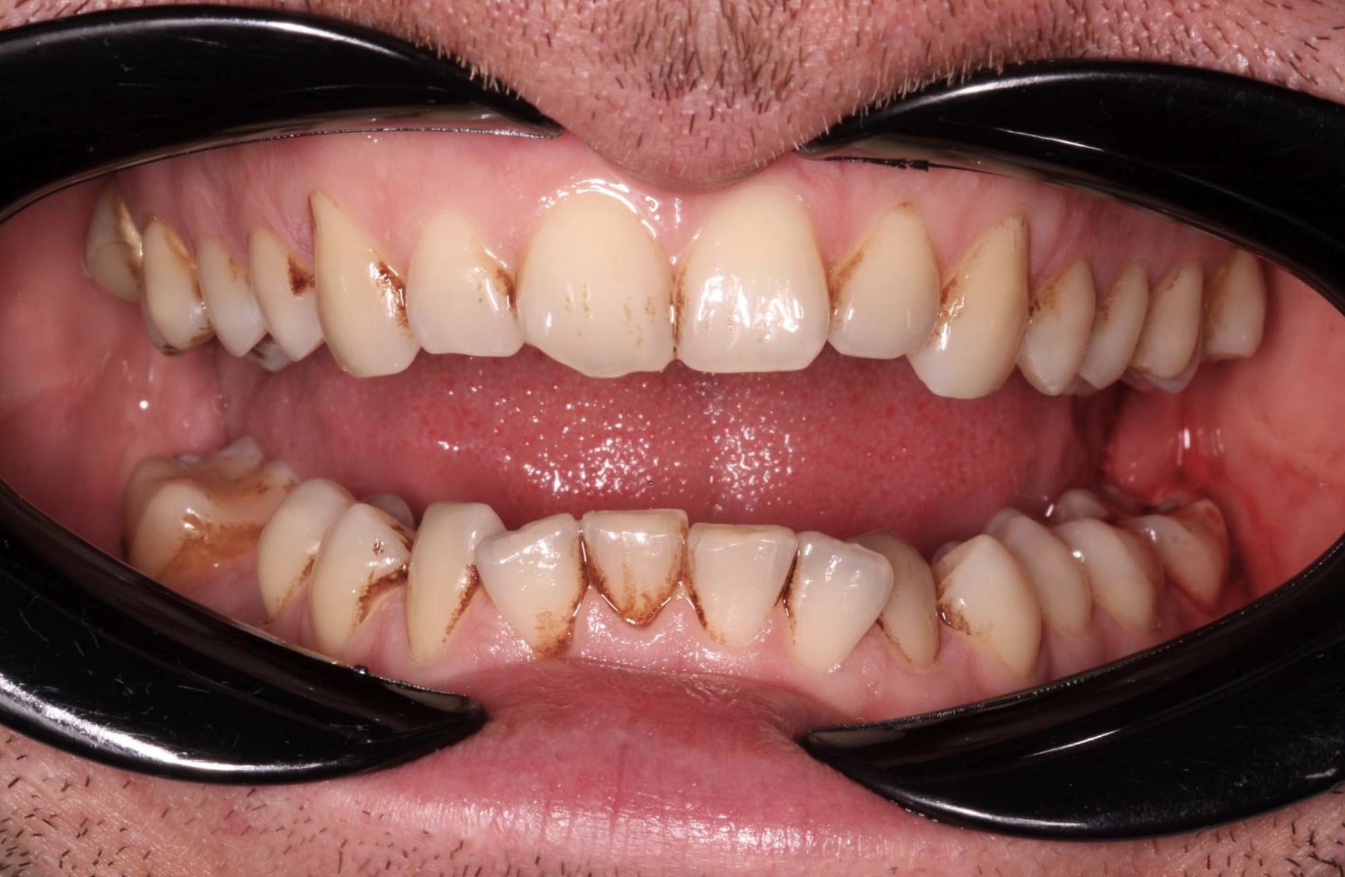 teeth before