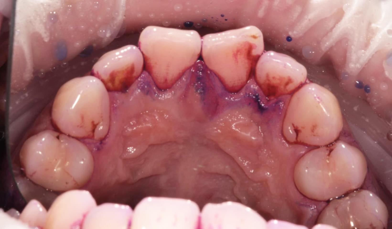 teeth after